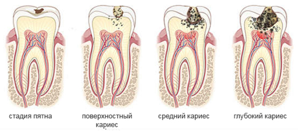 Лечение кариеса